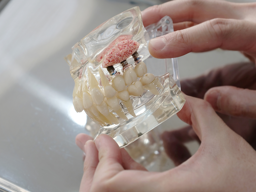 Four types of bone grafting for dental implants — socket preservation, ridge augmentation, sinus lift, major reconstruction