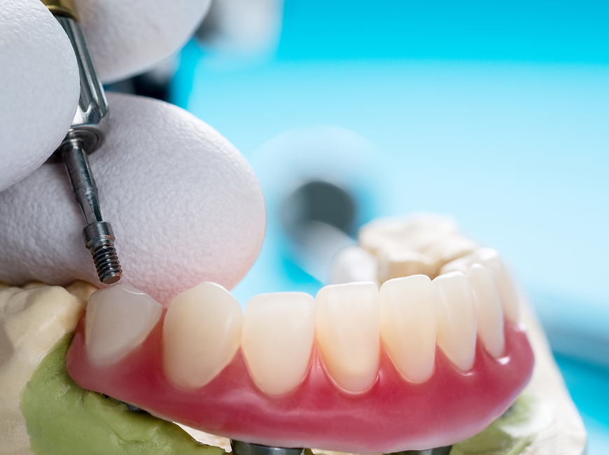 Traditional denture problems — slipping, bone loss, adhesive dependence