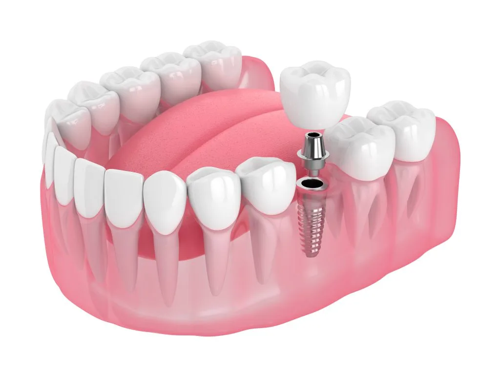 Single tooth