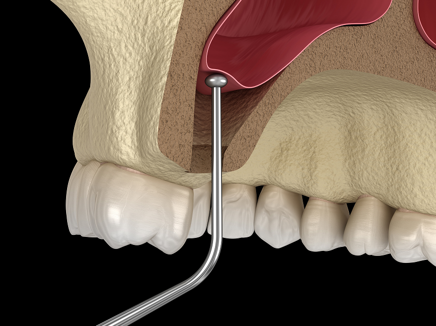 Crestal and lateral window sinus lift techniques for upper jaw dental implants